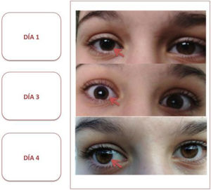 Se muestra la evolución de la anisocoria que presentaba la paciente a lo largo del ingreso. El día 1 corresponde a su llegada a Urgencias, donde se objetivaba una clara anisocoria con pupila midriática derecha, arreactiva a la luz. El día 3 corresponde a su estancia en planta, persistiendo anisocoria, aunque menos llamativa y con respuesta a la luz presente. El día 4 corresponde al momento del alta. Se aprecia una reducción progresiva y significativa del tamaño de la pupila derecha, siendo isocóricas y normorreactivas a la luz en el momento del alta.