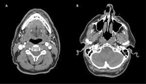 AngioTC de arterias supraaórticas. A)Se observa una asimetría en el calibre de ambas venas yugulares internas, con mayor diámetro en la vena yugular interna derecha. B)La dilatación se extiende hasta el bulbo yugular. Durante este trayecto, debido a su tamaño, mantiene un estrecho contacto con la arteria carótida interna.