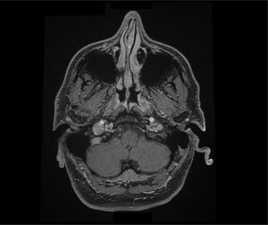 RMN axial T1 3D con contraste. Asimetría en el calibre de ambas venas yugulares, con un foramen yugular derecho prominente y contacto estrecho de la vena yugular con la arteria carótida interna derecha.