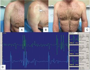Lesión de plexo cervicobraquial superior. Varón de 54 años con síndrome de Parsonage-Turner. A y B. Se observa amiotrofia del deltoides anterior y medio, y bíceps, con una asimetría clara entre extremidades (C). D. En el estudio electromiográfico se observa escaso reclutamiento de unidades motoras, intercalando potenciales pequeños con otros polifásicos de mayor tamaño (daño neurógeno crónico).
