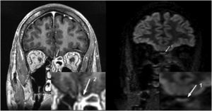 Left: Brain MRI. T1-BRAVO Coronal slice with paramagnetic contrast. The white arrow (2) points the olfactory bulbs, showing bilateral contrast enhancement. Right: Brain MRI. T2/FLAIR Coronal slice. The white arrow (1) points the olfactory bulbs, showing bilateral T2 hyperintensity.