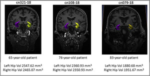 Three-dimensional reconstruction of the manual segmentation of the hippocampus, performed using the Amira software, from three study participants. The left hippocampus is shown in yellow and the right in magenta. Left Hip Vol: volume of the left hippocampus; Right Hip Vol: volume of the right hippocampus.