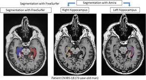 Comparison of results obtained with Amira and FreeSurfer for the segmentation of both hippocampi of a 72-year-old study participant. The red circles indicate areas outside the hippocampus that were incorrectly included by FreeSurfer. This is one of the reasons for the overestimation of volumes.19