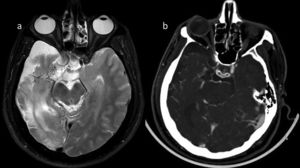 A 26-year-old male patient, vascular collateral structures (a) and parenchymal volume loss are present at the right MCA level on MRI (T2 weighted). CT angiography (b) indicates decreased right ICA calibration and vascular collateral structures at the MCA level. The findings are consistent with Moyamoya disease.