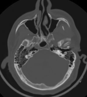 Right cerebral hemiatrophy, increased calvarial thickness on the right, and hyperaeration of the mastoid bone in a 28-year-old male patient (CT).