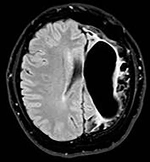 A 20-year-old female patient with left cerebral hemiatrophy and dilatation in compensatory lateral ventricles. Also, extensive encephalomalacia areas in the parenchyma and hyperaeration in the frontal sinuses (MRI Flair).