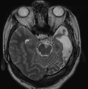 A 17-year-old female patient with cerebral hemiatrophy and parenchymal volume loss in the left half of the brainstem compared to the right (T2 weighted MRI).