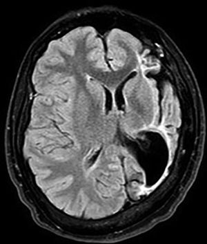 A 22-year-old patient with left cerebral hemiatrophy, ipsilateral atrophy of the basal ganglia (MRI Flair).