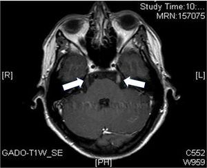 T1-weighted axial MRI sequences with gadolinium contrast. Enhancement of left cranial nerve V (solid arrow) and lower right (hollow arrow).