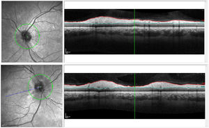 Top: OCT-RNFL of the right eye. Bottom: OCT-RNFL of the left eye.