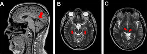MRI scan of a young patient with post–COVID-19 cognitive impairment. A) Mild loss of cerebellar volume. B) and C) Prominent perivascular spaces in the bilateral hippocampus (B) and basal ganglia (C).