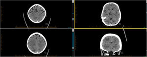 (clockwise from the left upper image): Admission CT Brain was normal (A), but a repeat showed new bilateral occipito-parietal and equivocal cerebellar abnormalities (B–D).