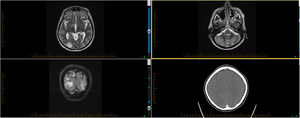 (clockwise from the left upper image): MRI revealed predominant posterior white matter abnormalities within the occipital lobes and cerebellum, and some haemorrhagic change right occipital lobe (A–C). A repeat CT angiography three days after the MRI showed no features of vasculitis (D).