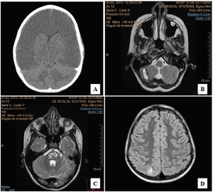 A) Non-contrast cranial CT: diffuse parenchymal hypoattenuation, loss of cortico-subcortical differentiation, and collapse of the ventricular system, compatible with diffuse cerebral oedema. B) Brain MRI (T2-weighted, axial plane): oval hyperintensity with a hypointense halo in the right cerebellar hemisphere, compatible with haematoma. C) Brain MRI (T2-weighted, axial plane): hyperintensity affecting nearly the entire central region of the pons, suggestive of central pontine myelinolysis. D) Brain MRI (FLAIR, axial plane): patchy hyperintensities in the juxtacortical and subcortical white matter of the parieto-occipital region of the right hemisphere.
