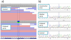 (A) Variant shown with the Integrative Genomics Viewer. (B) Familial cosegregation analysis conducted by conventional sequencing.
