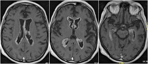 Intraventricular melanoma metastasis. Axial T-1 postdadolinium brain MRI sequences demonstrate nodular IVT enhancing lesions.