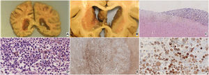 Histopathology of brain autopsy. A–B, Macroscopic examination demonstrates a granular brownish colored irregular lesion that lines the inner surface of the lateral ventricles bilaterally, including the septum pellucidum. C, H&E staining demonstrates a very cellular solid lesion with an ependymal–subependymal distribution that lines ventricular walls. D, H&E shows groupings of large cells with an epithelioid habit with large, oval and highly hyperchromatic nuclei, with a very marked pleomorphism and prominent nucleoli. There are abundant mitosis figures, necrotic areas, intense melanic pigment, and binucleated cells that are relatively common in melanoma. E, positive S-100 staining. F, positive melan-A staining