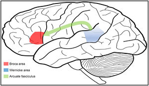 Classical or anatomical lesional model of language, including the Broca area (red), associated with expression, the Wernicke area (blue), associated with verbal comprehension, and the arcuate fasciculus (green), associated with repetition.