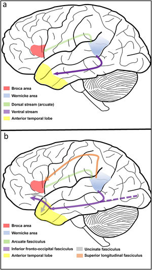 a) Representation of the two-stream model,(16) with a dorsal stream connecting the Broca area to the Wernicke area, related to verbal expression, and a ventral stream connecting the Wernicke area to the temporal lobe, related to comprehension. b) Extended two-stream model,(17) including the superior longitudinal fasciculus and the arcuate fasciculus in the dorsal stream and the uncinate fasciculus and the inferior fronto-occipital fasciculus in the ventral stream.
