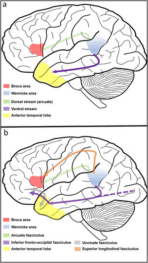 a) Representation of the two-stream model,(16) with a dorsal stream connecting the Broca area to the Wernicke area, related to verbal expression, and a ventral stream connecting the Wernicke area to the temporal lobe, related to comprehension. b) Extended two-stream model,(17) including the superior longitudinal fasciculus and the arcuate fasciculus in the dorsal stream and the uncinate fasciculus and the inferior fronto-occipital fasciculus in the ventral stream.