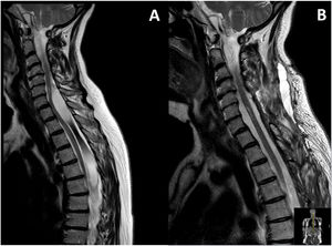 A) Cervical and thoracic spinal MRI scan. T2-weighted sequence showing 2 spinal arachnoid cysts. The lesion caused greater spinal cord compression at the C7-T1 level and myelopathy at C6. B) Postoperative MRI scan showing spinal cord decompression and residual myelopathy at C6-C7.