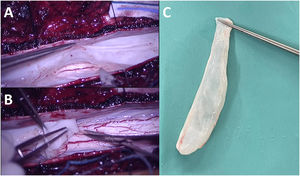 A and B) Intraoperative images showing progressive detachment of the cyst from the spinal cord. C) Surgical specimen showing the cyst, with smooth, well-delimited walls and a “finger-in-glove” shape.