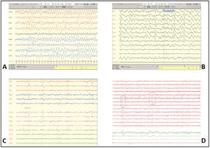 (A) The first EEG study, showing generalised delta activity with spike-wave patterns and dominant bifrontal projection, consistent with status epilepticus. (B) EEG performed on day 15, after the caesarean section, showing periodic, lateralised, predominantly bifrontal discharges. (C) EEG performed on day 27, during barbiturate coma therapy, showing a burst-suppression pattern. (D) Final EEG, showing normal brain activity with occasional, predominantly temporal theta activity.