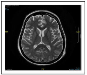 Final MRI study (day 32), revealing no relevant findings.
