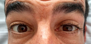 Image showing left incomplete Horner syndrome, ptosis and miosis without anhidrosis.