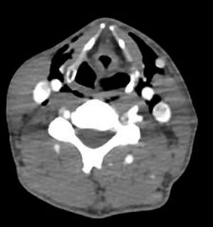 Cervical CT angiography shows moderate emphysema in the bilateral latero-cervical region with no signs of carotid or vertebral artery dissection.