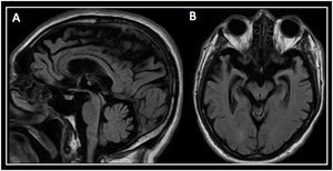 MRI of the patient. Panel A (Sagittal FLAIR) shows the hummingbird sign in which the preserved pons forms the body of the bird, and the atrophic midbrain the head, with beak extending anteriorly. Panel B (Axial FLAIR) exhibits the morning glory sign where the tegmentum is concave.