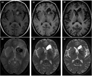Changes in the size of the cystic lesion on T1- (1A, 1C, 1E) and T2-weighted MRI sequences (1B, 1D, 1F) from the time of its diagnosis in 2015 (1A and 1B) to its maximum size in 2017 (1C and 1D) and subsequent reduction in size in 2019 (1E and 1F).