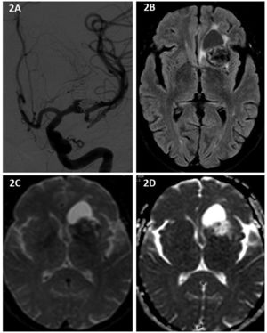 Permeable residual neck after re-embolisation in 2016 (2A). The subsequent follow-up study (2017) detected a hypointense cyst and white matter alterations on FLAIR sequences (2B) and facilitated diffusion on DWI (2C) and ADC sequences (2D).