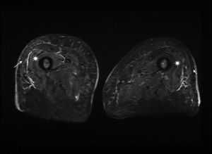 MRI scan of the thighs. STIR sequence, axial plane. Bilateral, symmetric myofascial oedema (asterisks) involving the bellies of muscles in the anterior compartment of the thigh. Oedema involving the adjacent subcutaneous tissue and skin thickening (arrow).