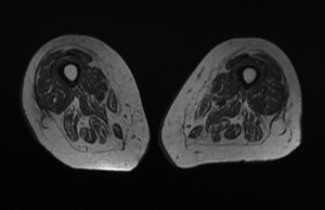 MRI scan of the thighs. T1-weighted sequence, axial plane. The image does not reveal muscle atrophy or fatty infiltration in the affected compartments, which suggests an acute/subacute course.