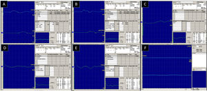 Electroneuromyography showing no impairment of motor branches of the median and ulnar nerves (A, B), impairment of sensory branches of the right median, ulnar, and superficial radial nerves (C, D, E), and absence of acute activity in the form of spontaneous denervation of the right deltoid muscle (F).