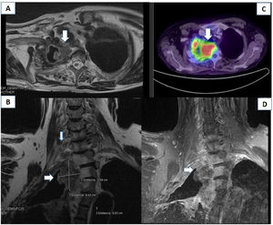 (A) Lung CT scan showing a mass in the apex of the right lung, causing ganglion compression and T2 displacement and invasion. (B and D) An MRI scan of the right brachial plexus (coronal section, STIR and T1FSE sequences) showed a mass measuring 3.58 × 4.42 cm at the level of the lung apex and displacing the T1–T3 vertebral bodies, reaching the roots of the distal brachial plexus. (C) PET-CT scan revealing increased 18F-FDG uptake in the mass.