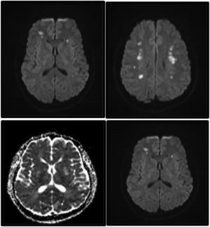 MRI study. Axial DWI/ADC sequence at the level of the basal ganglia and centrum semiovale, showing multiple small acute ischaemic lesions in both hemispheres.