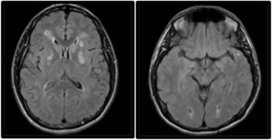 MRI study performed 2 weeks after symptom onset. Axial non-contrast FLAIR sequence showing persistent hyperintensity of the lesions affecting both lenticular nuclei, predominantly in the left hemisphere. The image also reveals hyperintensities in the subcortical white matter of both temporal poles, a typical finding in CADASIL.