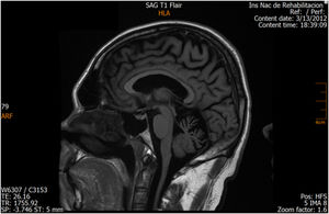 Sagittal FLAIR MRI. Atrophy of the superior vermis and cervical spine is noticeable.