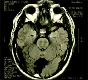 Axial FLAIR MRI. Pontine striae and a retrovermian cyst.