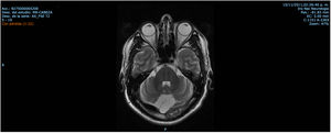 Axial T2 MRI. Lobulated retrovermian cyst.
