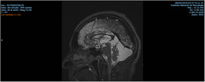 Sagittal T2 MRI. Retrovermian cyst and cerebellar atrophy.