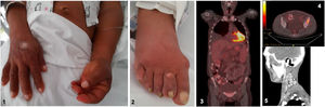 General findings in patients with POEMS syndrome. Panel 1 and 2. Patient with hyperpigmentation and skin thickening. Acrocyanosis in the extremities, edema, and ascites. Panel 3 and 4. Body FDG PET-CT: no unusual metabolic changes are observed but she has hepato-splenomegaly. Body FDG PET-CT: hypermetabolic lesion in left iliac crest, later characterized by biopsy as a plasmacytoma. Panel 5. CT scan of the neck showing a cervical lymph node conglomerate.