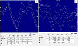 Visual evoked potentials using a checkerboard pattern (pattern VEP) in patient 33. A) Demyelinating lesion with increased P100 latency (131–135 ms) in right eye (prechiasmatic lesion). B) P100 amplitude and conduction velocity within normal ranges in left eye.