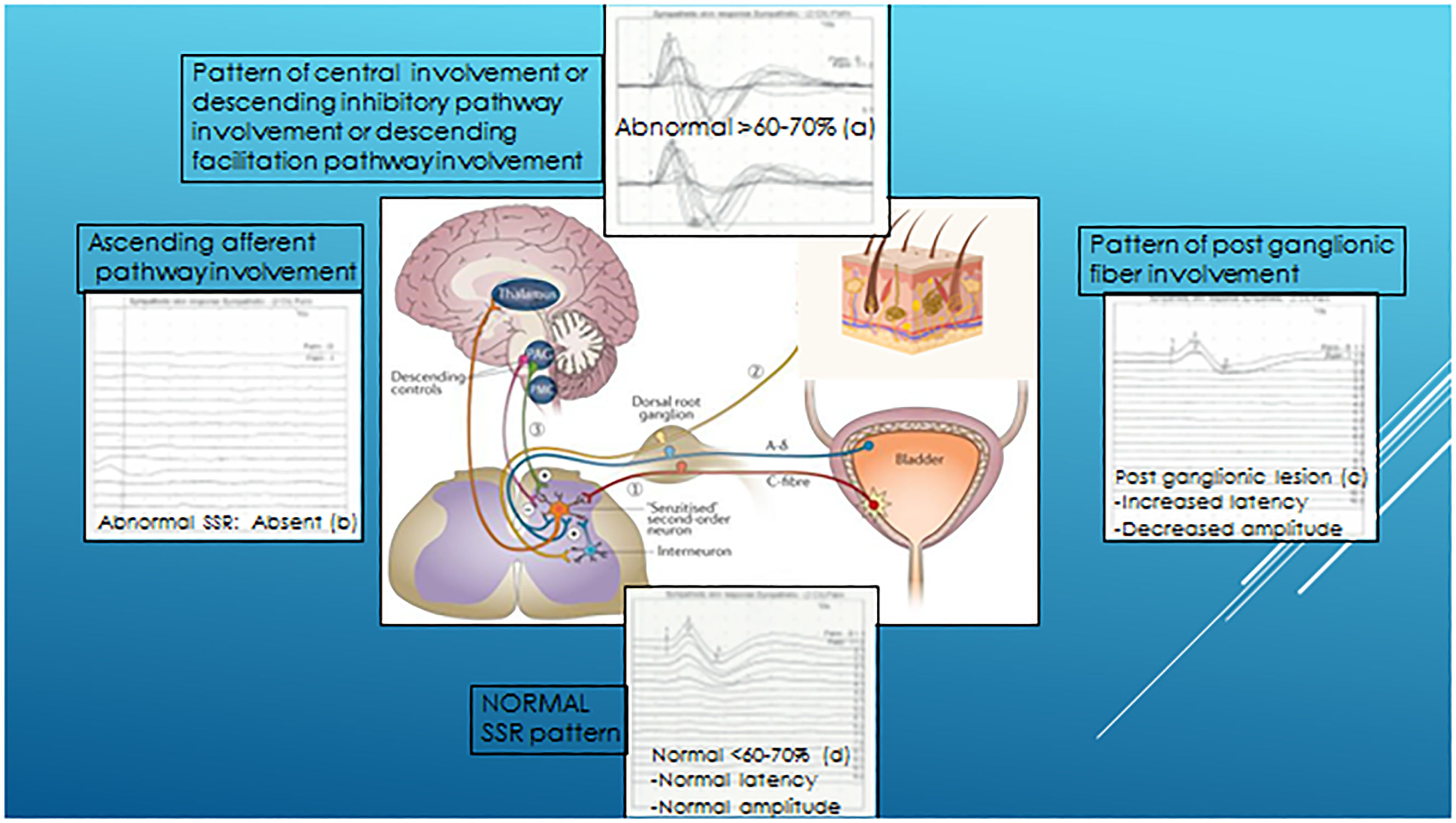 Hyperactive Bladder Overactive bladder, lack of habituation, and central sensitisation: The ...