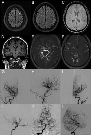 Imaging study in the patient presented. A–F. Brain magnetic resonance (MR) study. Axial T2 FLAIR images showed chronic cortical lesions in the left frontal cortex (A), and several subcortical gliotic foci in the white matter of both hemispheres (B). C. Axial SWI image evidenced deep left periventricular microbleed. D. Coronal T1 image showed hippocampal asymmetry suggestive of left hippocampal malrotation. E, F. Axial time of flight (TOF) MR sequence showed severe bilateral stenosis at the terminal internal carotid artery portion, decreased flow signal in M1 segments of both middle cerebral arteries, an increase in the diameter of both posterior cerebral arteries, as well as, abundant collateral vessels in basal ganglia and basal cisterns, which were more predominant in the right hemisphere. Pial collateral vessels were also observed (F). Altogether, these changes resulted in a decreased flow in both hemispheres, especially in the left one (E, F). G–L. Cerebral arteriography study in the patient. Anterior (G, I) and lateral (H, J) projection views showed critical stenosis at the terminal portion of right (G, H) and left (I, J) internal carotid arteries, together with an important network of collateral vessels originating from the lenticulostriate, ophthalmic and anterior choroidal arteries (G–D). Posterior (K) and lateral (L) projection views showed increased bilateral posterior cerebral artery diameter (K) and multiple pial collaterals from the posterior cerebral arteries (L). No extra-intracranial anastomoses were observed. Altogether, these findings confirmed the diagnosis of moyamoya disease, classified as Suzuki and Takaku's stage III.