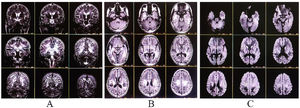 MRI of the brain revealed non-enhancing altered intensity lesions hyper on coronal-T2-WI (A), axial-T2-WI (B), and axial-DWI (C) involving bilateral temporal-parietal-occipital region, posterior limb of the internal capsule, thalamus, and splenium of the corpus callosum with adjacent dilated sulci and dilated occipital horns of both lateral ventricles suggestive of posterior-predominant leukodystrophy.