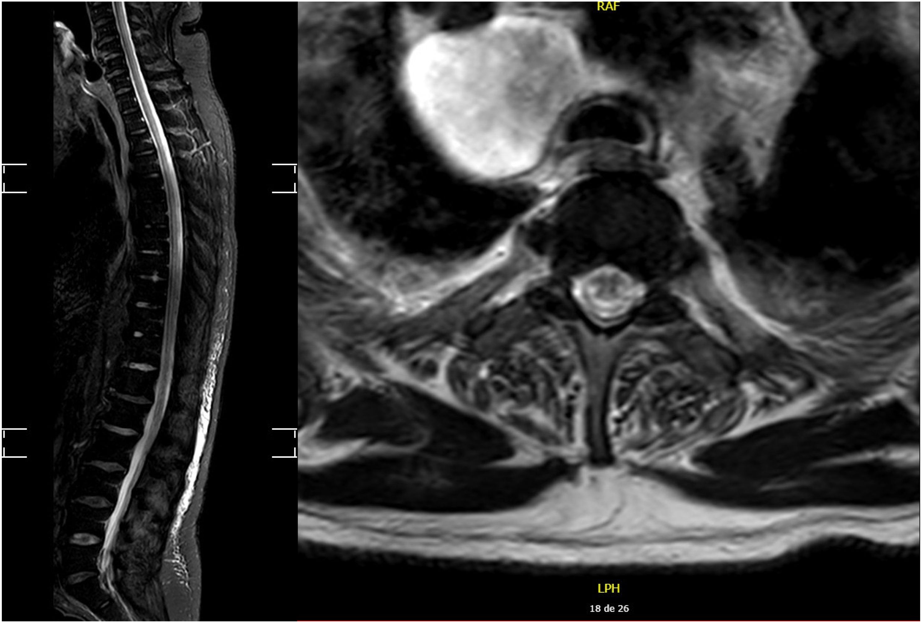 Cobalamin (vitamin B12) deficiency: A reversible cause of myelopathy ...