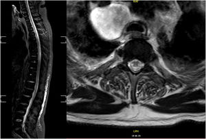 Sagital contrast-enhanced cervical spine MRI image shows longitudinally extensive hyperintensity signal involving posterior columns tracts. Axial T2 spine MRI showing hiperintensity involving bilateral lateral and posterior columns tracts.